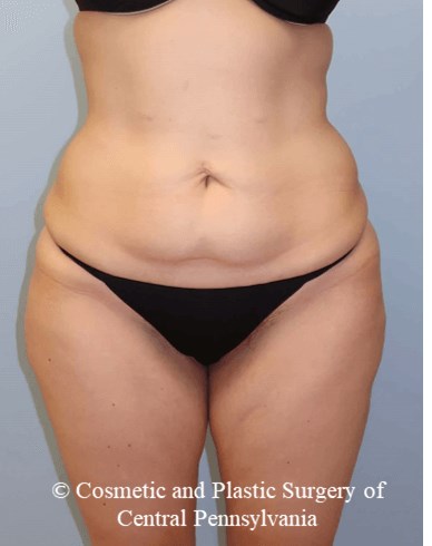 Circumferential Body Lift Before
