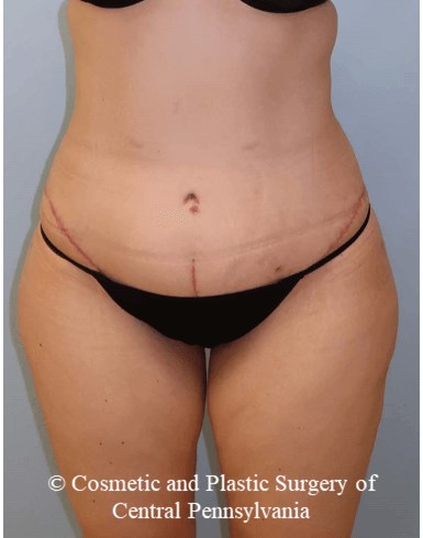 Circumferential Body Lift After