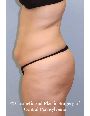 Circumferential Body Lift Before