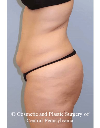 Circumferential Body Lift Before