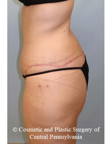 Circumferential Body Lift After