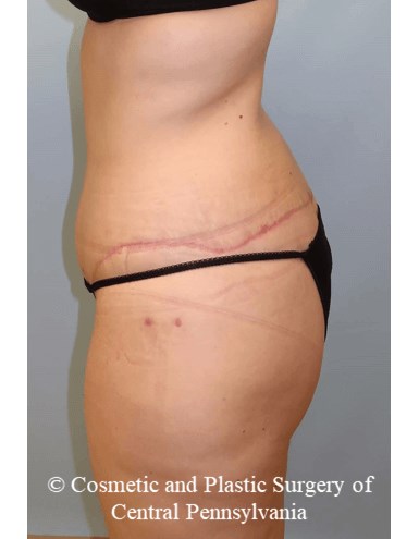 Circumferential Body Lift After