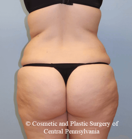 Circumferential Body Lift Before