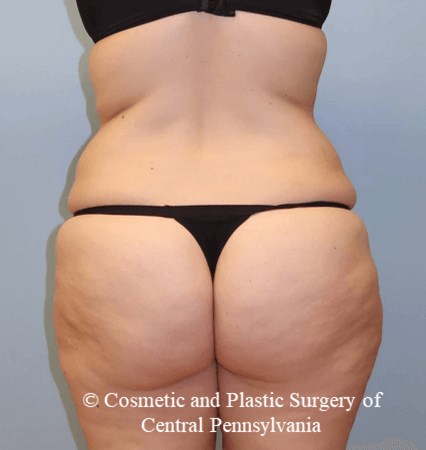 Circumferential Body Lift Before