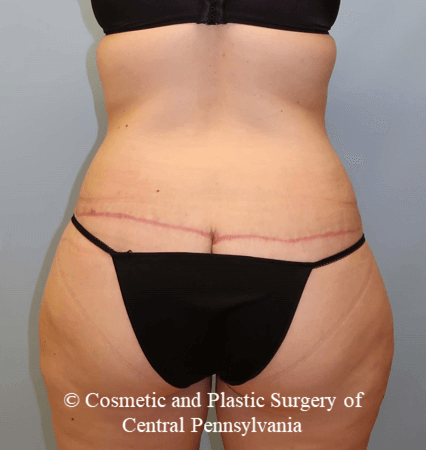 Circumferential Body Lift After