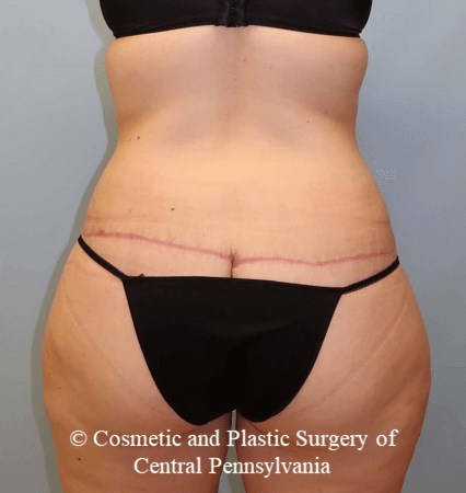 Circumferential Body Lift After
