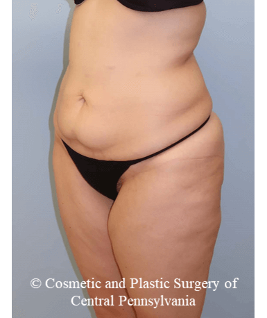 Circumferential Body Lift Before