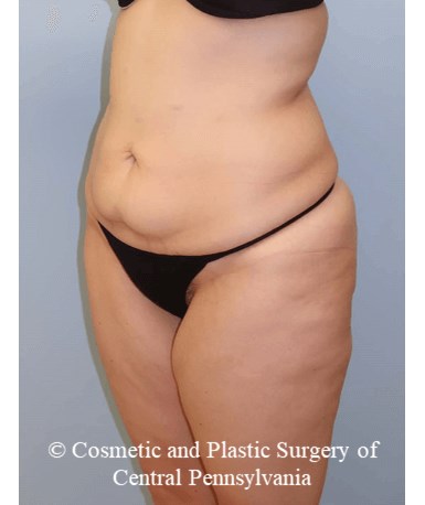 Circumferential Body Lift Before