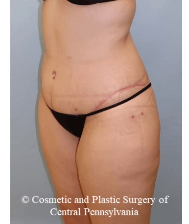 Circumferential Body Lift After