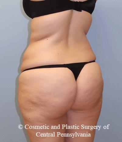 Circumferential Body Lift Before