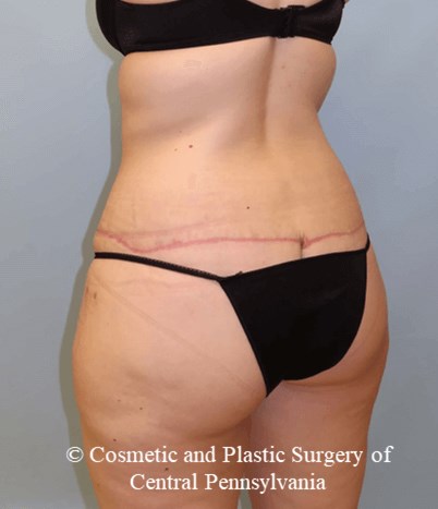 Circumferential Body Lift After