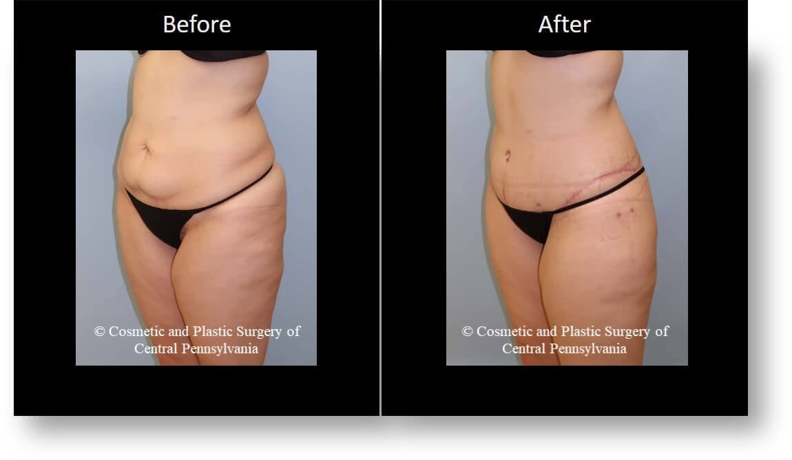 weight loss before and after women legs