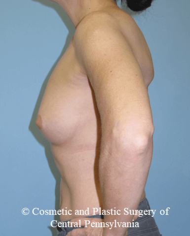 Breast Reconstruction Before