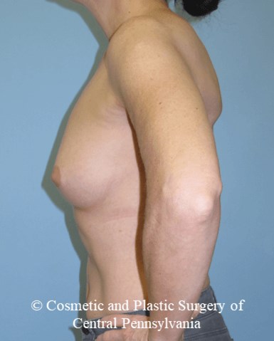 Breast Reconstruction Before