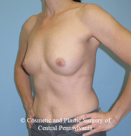 Breast Reconstruction Before