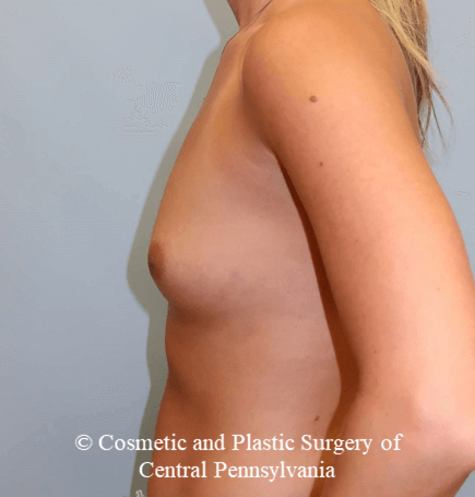 Breast Augmentation Before