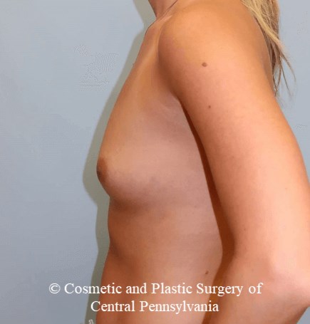 Breast Augmentation Before