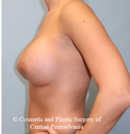 Breast Augmentation After