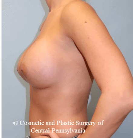 Breast Augmentation After