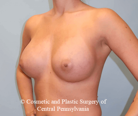 Breast Augmentation After