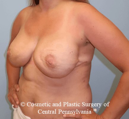 Breast Reconstruction After