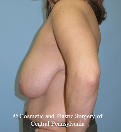 Breast Reconstruction Before