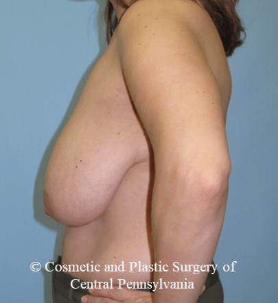 Breast Reconstruction Before