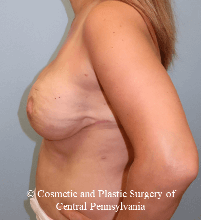 Breast Reconstruction After