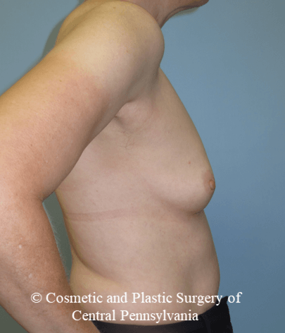 Breast Reconstruction Before