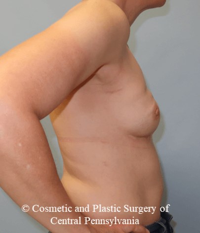 Breast Reconstruction After