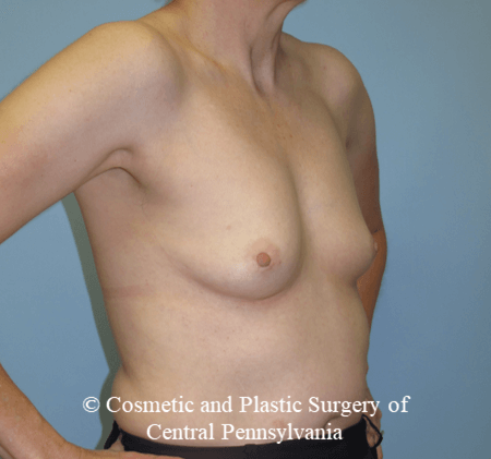 Breast Reconstruction Before