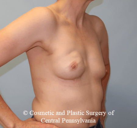 Breast Reconstruction After