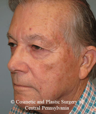 Blepharoplasty (upper eyelid) Before
