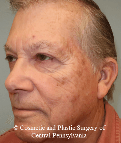 Blepharoplasty (upper eyelid) After