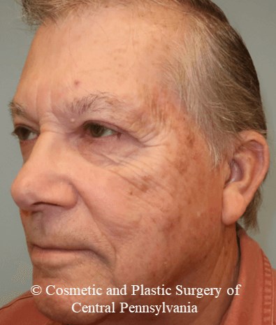 Blepharoplasty (upper eyelid) After