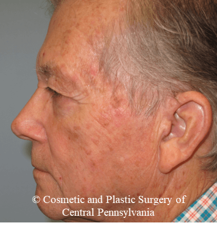 Blepharoplasty (upper eyelid) Before