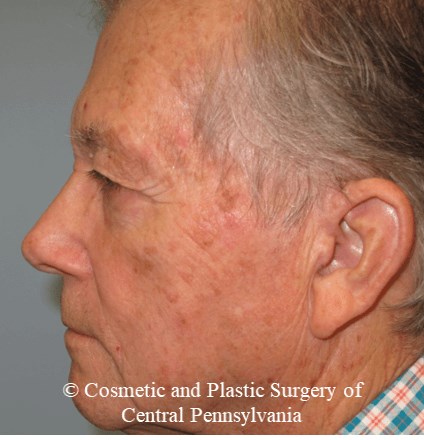 Blepharoplasty (upper eyelid) Before