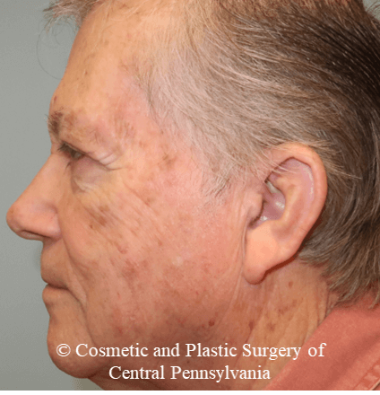 Blepharoplasty (upper eyelid) After