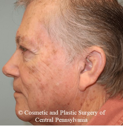 Blepharoplasty (upper eyelid) After
