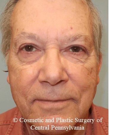Blepharoplasty (upper eyelid) After