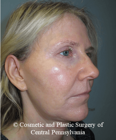 Facelift M.A.C.S. Before