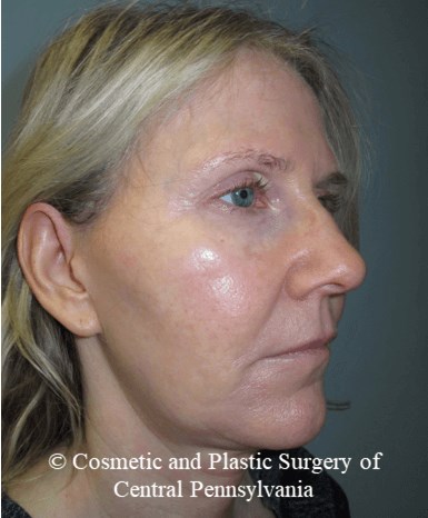 Facelift M.A.C.S. Before