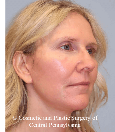 Facelift M.A.C.S. After