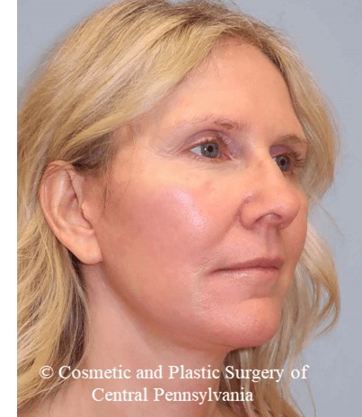 Facelift M.A.C.S. After