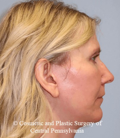 Facelift M.A.C.S. After