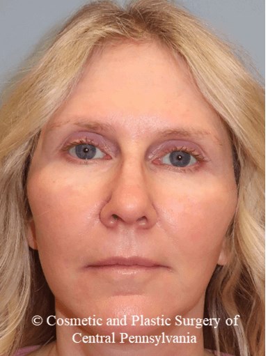 Facelift M.A.C.S. After
