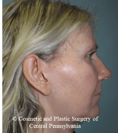 Facelift M.A.C.S. Before