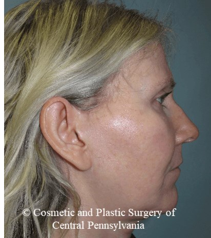 Facelift M.A.C.S. Before