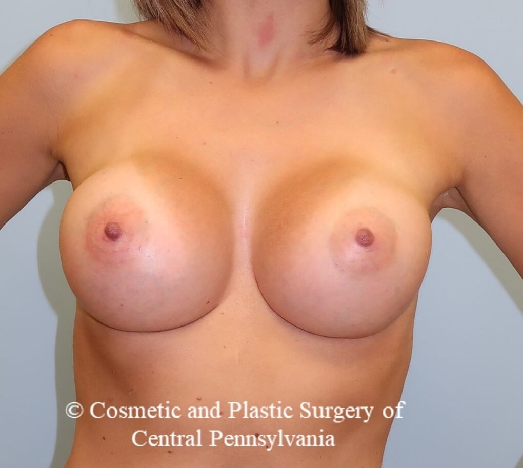 Breast Augmentation After