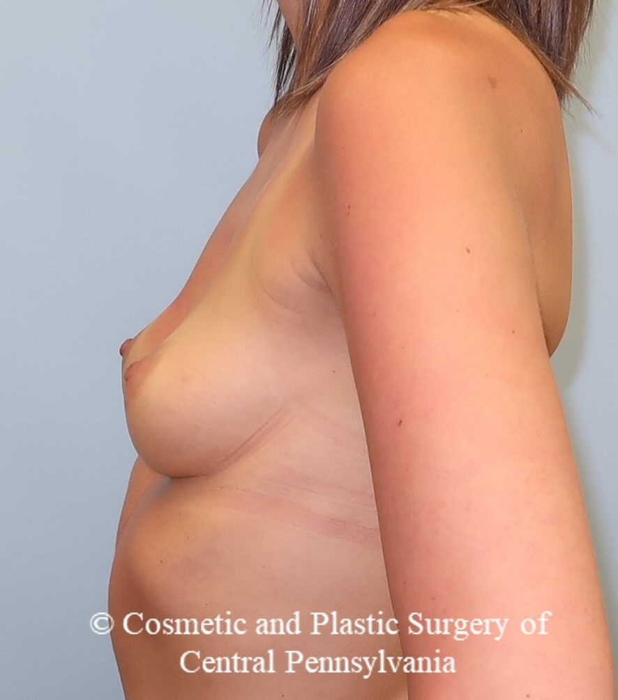 Breast Augmentation Before